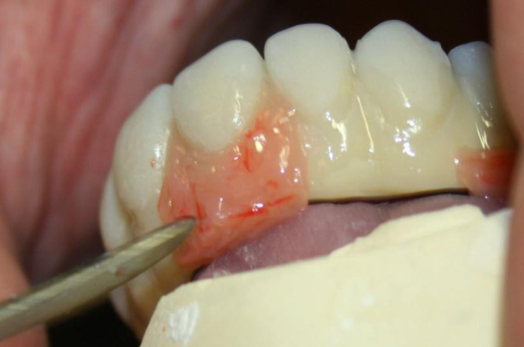 Immediate loading all on 4 dental implants