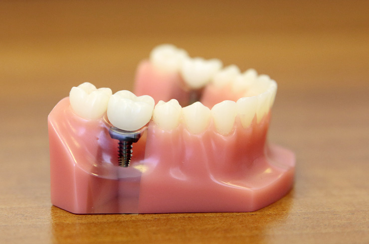 Dental implant restorations