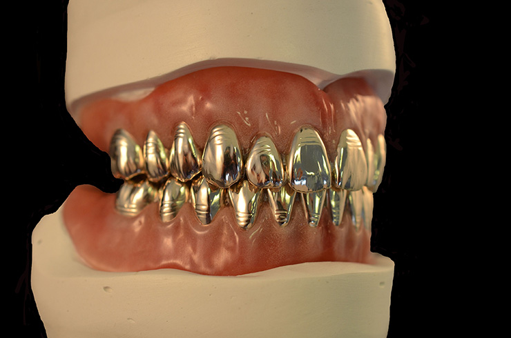 Gold dentures - Dental Laboratory in Bolton