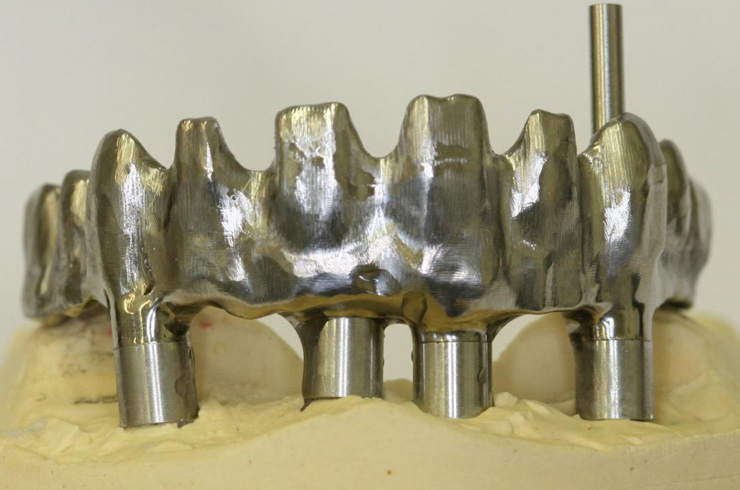 Immediate loading all on 4 dental implants